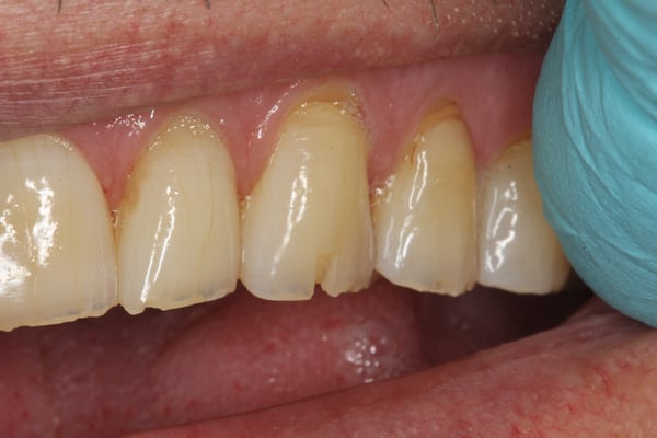 Seamless Incisal Edge Repair Using Omnichroma Composite 